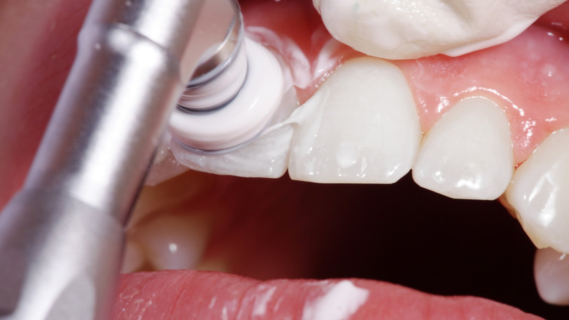 ¿Existe el dolor en la limpieza dental profesional?