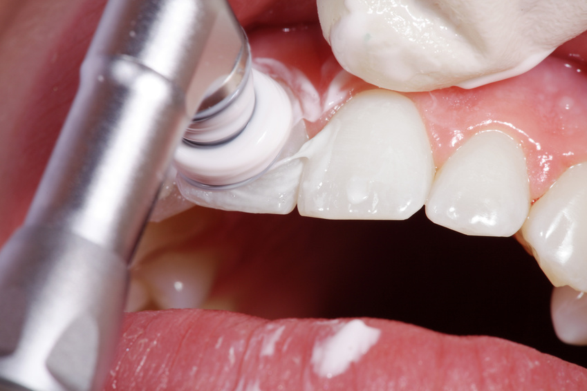 Is professional dental cleaning painful?